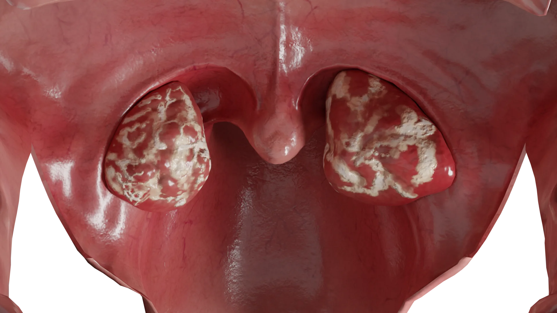Tonsillitis Symptoms – Sore Throat Signs In Children