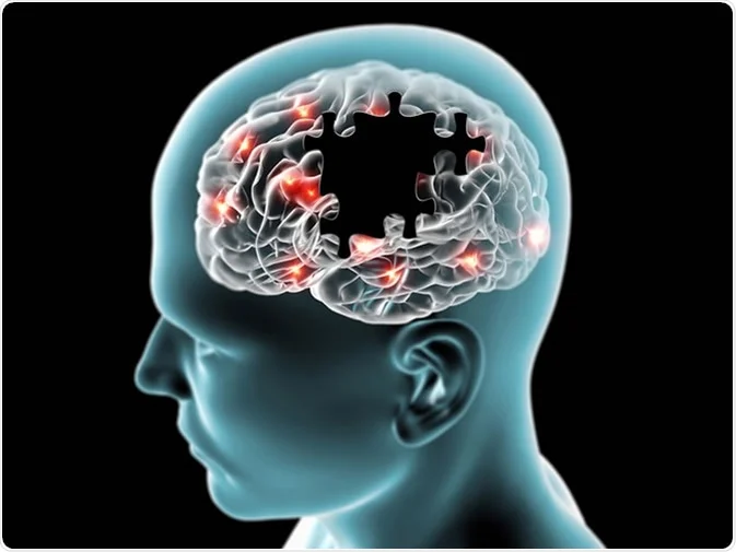 Alzheimer's Symptoms – Memory Loss Stages Explained Clearly