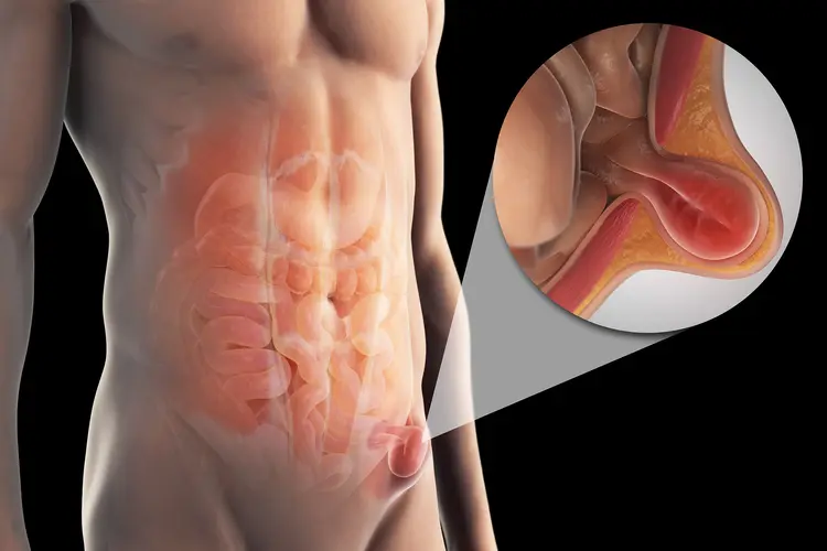 Hernia Symptoms: A Bulge, Pressure, and Pain While Lifting