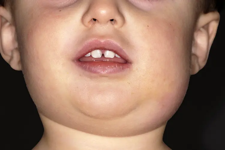 Mumps Symptoms: Swollen Glands, Puffy Cheeks, and Jaw Pain