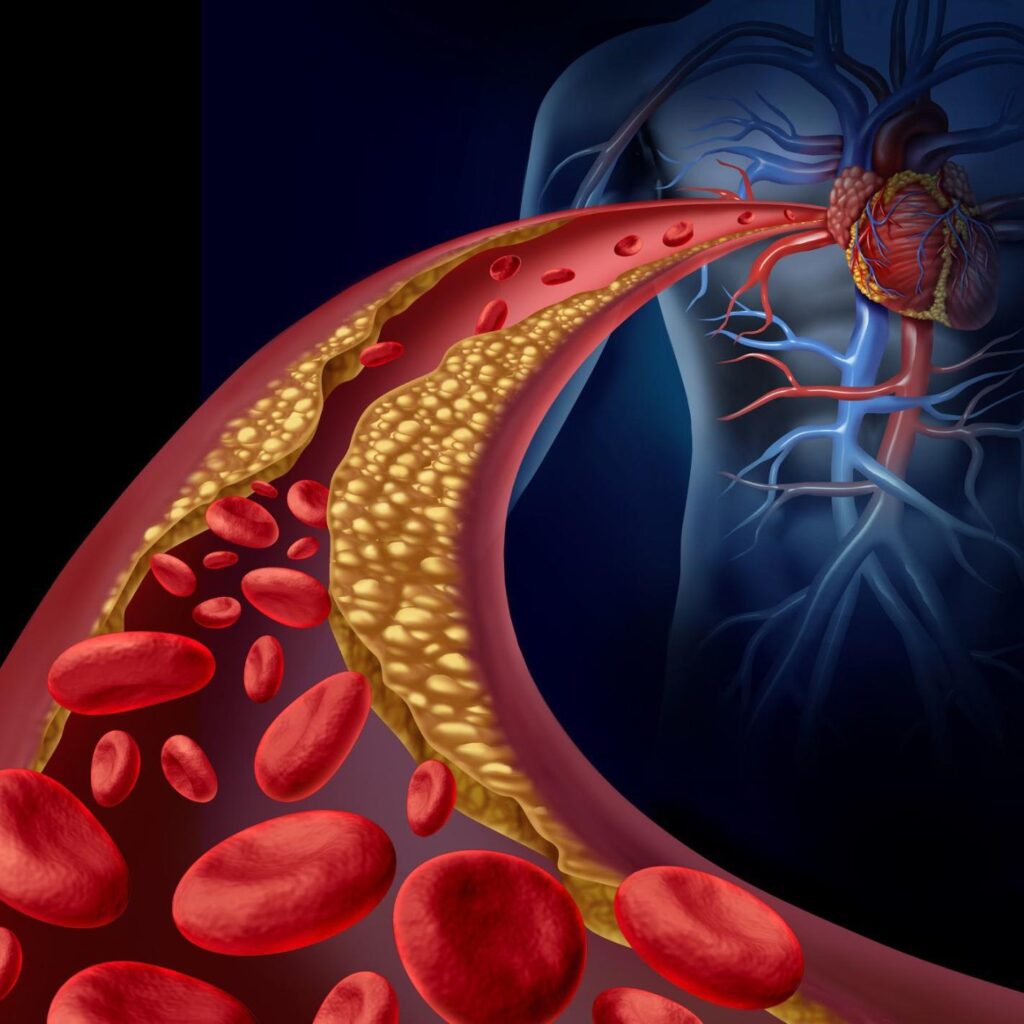 High Cholesterol Symptoms – Silent Signs In Your Body