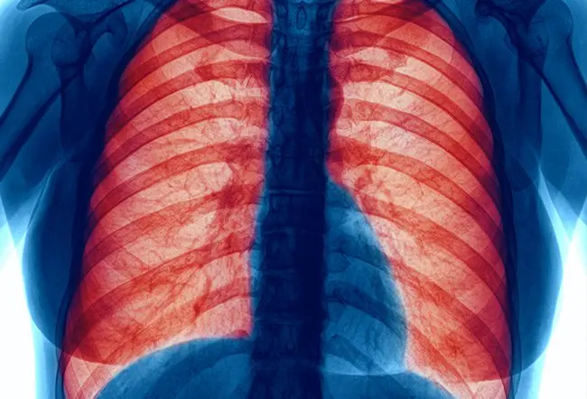 Emphysema Symptoms – Lung Damage Signs In Smokers
