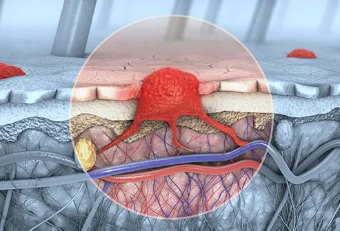Skin Cancer Symptoms – Mole Changes Signaling Real Danger